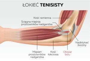 łokieć-tenisisty-ból-łokcia